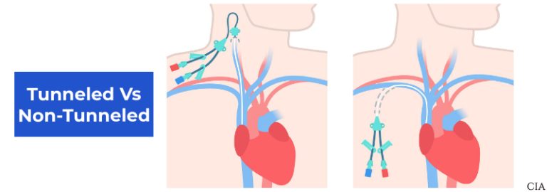 Tunneled vs Non-Tunneled Catheter: Key Differences Explained